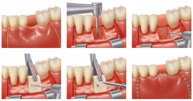 Exploring Root Canal Methods: Advanced Techniques for Dental Preservation